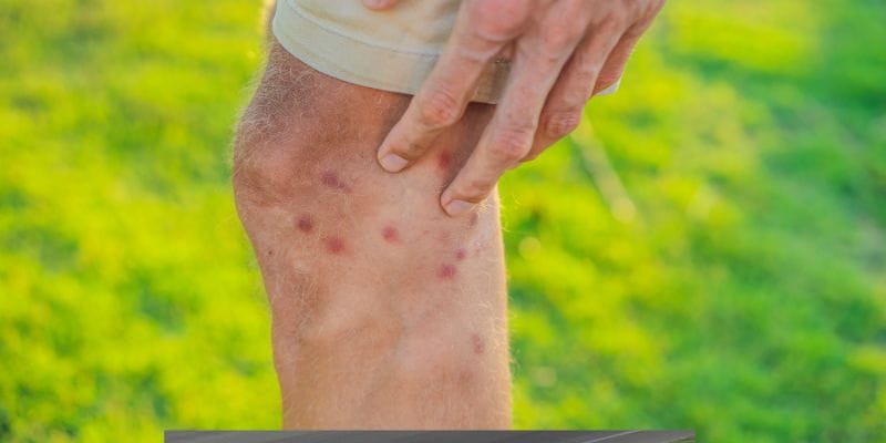 Why Does Mosquito Bites Leave Scars 