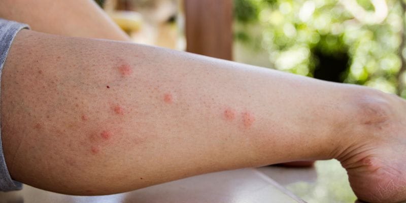 Why Does Mosquito Bites Leave Scars 